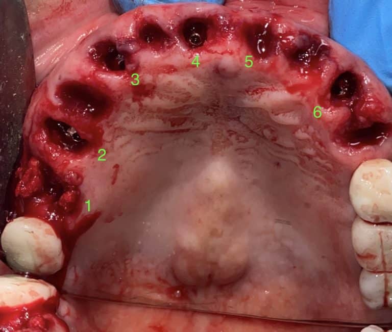 After Image: 6 Dental Implants Placement without Surgical Incisions or Flaps for a Full-Arch Implant Prosthesis - front