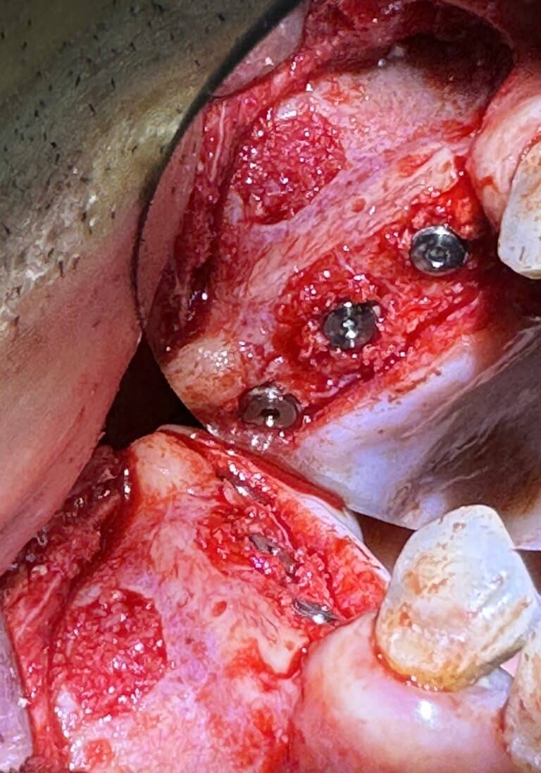 After Image: *Graphic Image* Bone Block Graft Harvested from Lower Jaw to Upper Left Quadrant - front