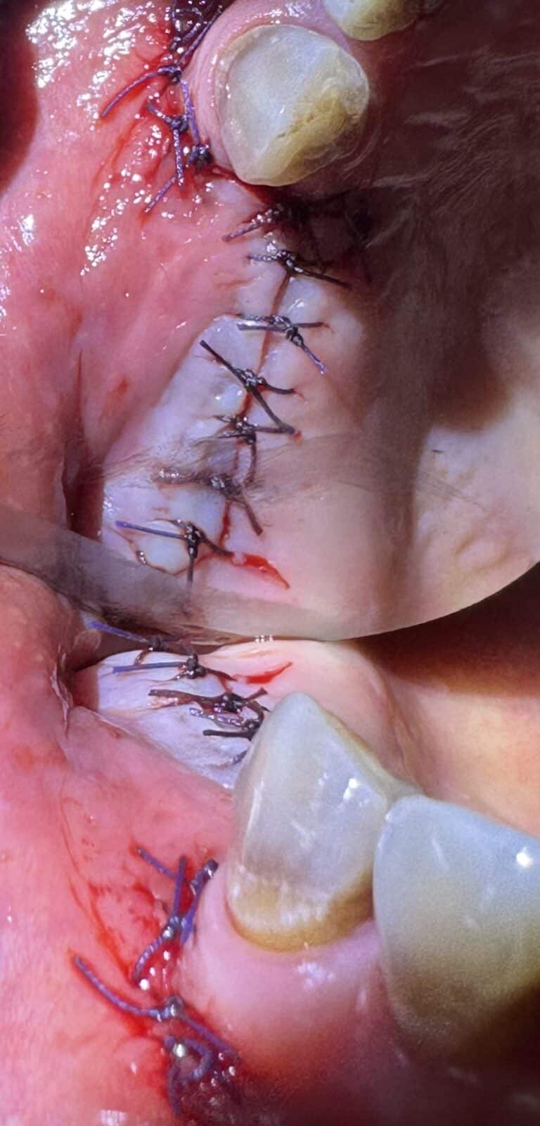 After Image: *Graphic Image* Bone Block Graft Harvested from Lower Jaw to Upper Left Quadrant - front