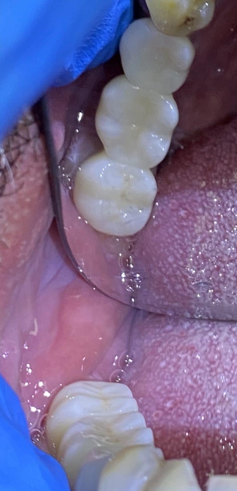 After Image: 3 Posterior Dental Implants with Bone Block Graft Transplant - front