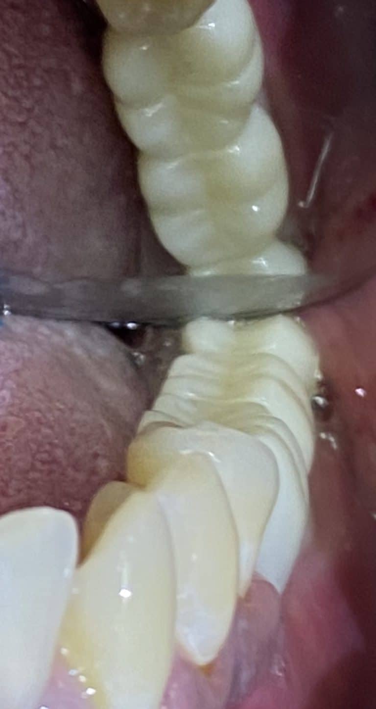 After Image: 3 Dental Implants in Lower Left Quadrant with Bone Block Graft - front