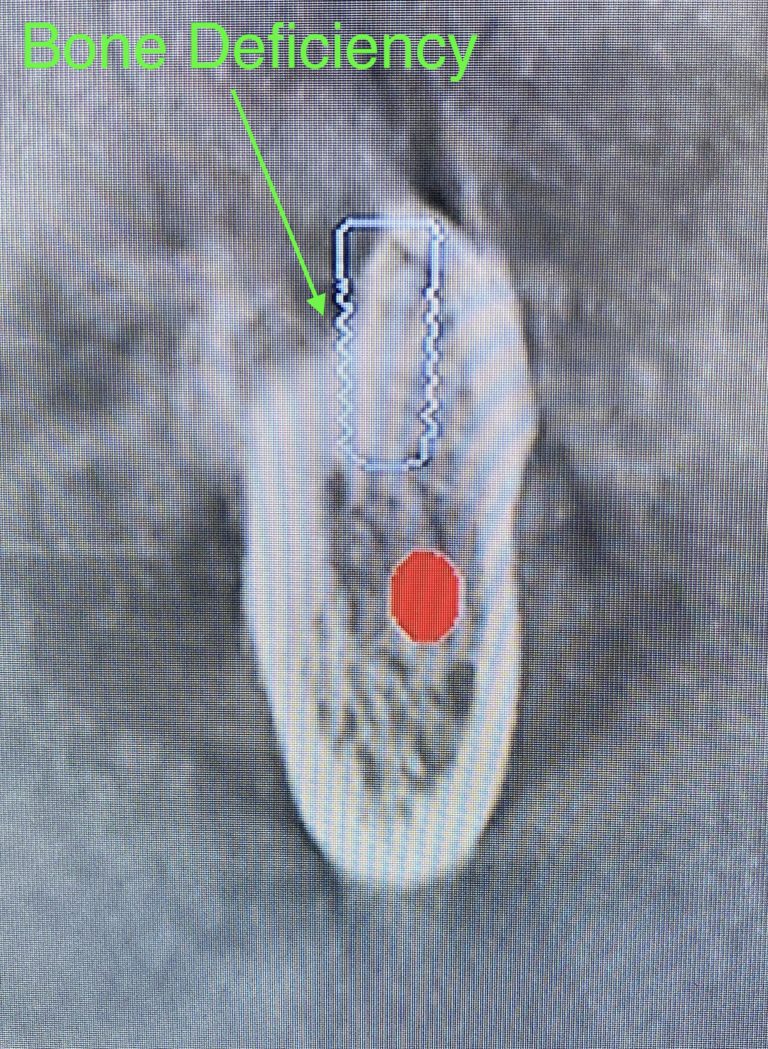Before Image: 3 Posterior Dental Implants with Bone Block Graft Transplant - front
