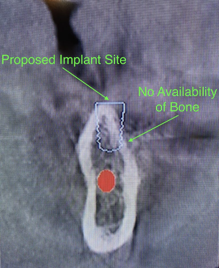 Before Image: 3 Dental Implants in Lower Left Quadrant with Bone Block Graft - front