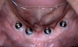 After Image: Denture Conversion for an Old Denture after 4 Dental Implants Placement