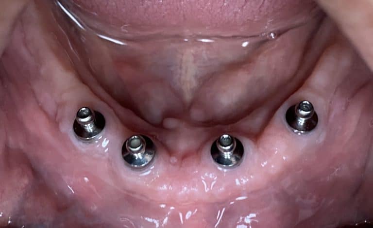 After Image: Denture Conversion for an Old Denture after 4 Dental Implants Placement - front