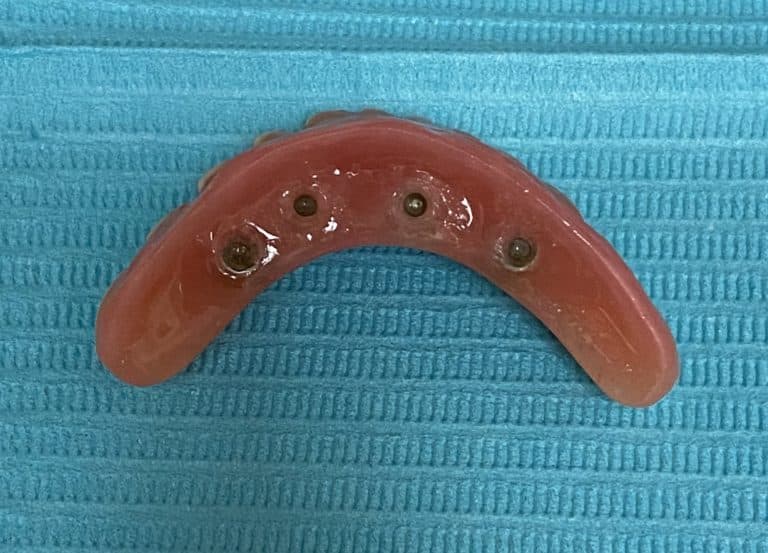 After Image: Denture Conversion for an Old Denture after 4 Dental Implants Placement - front