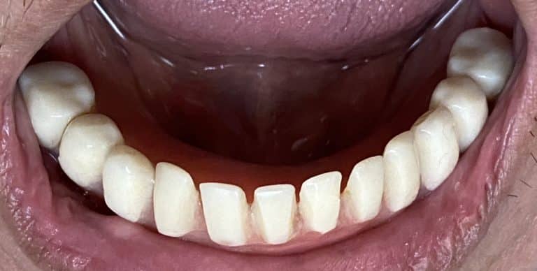 After Image: Denture Conversion for an Old Denture after 4 Dental Implants Placement - front