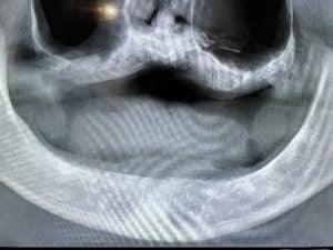 Before Image: Denture Conversion for an Old Denture after 4 Dental Implants Placement