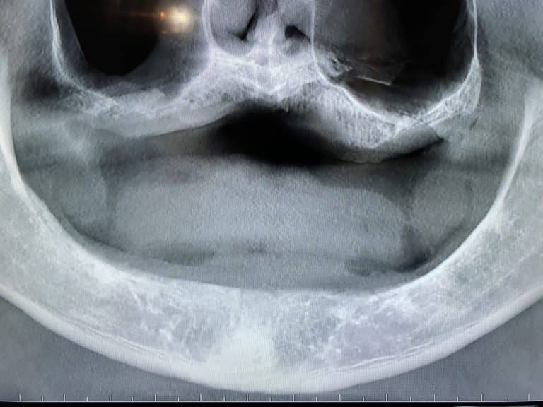 Before Image: Denture Conversion for an Old Denture after 4 Dental Implants Placement - front