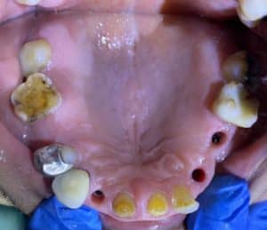 Before Image: Upgrading to a Full-Arch Prosthesis with 6 Additional Implants undergoing Flapless Surgery