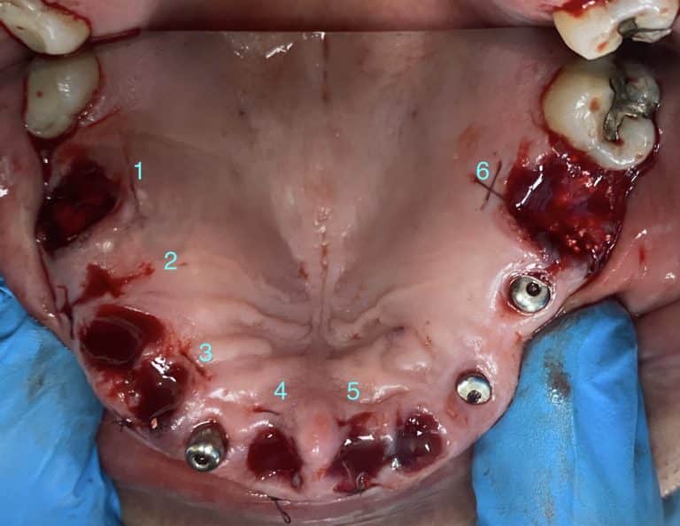 After Image: Upgrading to a Full-Arch Prosthesis with 6 Additional Implants undergoing Flapless Surgery - front