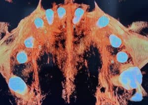 After Image: Upgrading to a Full-Arch Prosthesis with 6 Additional Implants undergoing Flapless Surgery