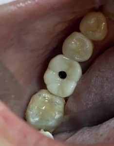 After Image: Single Implant Placement in Posterior Region
