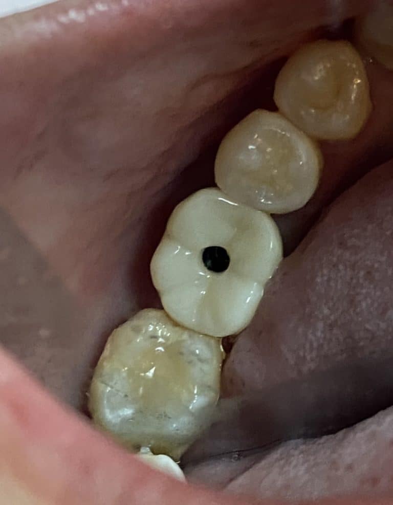 After Image: Single Implant Placement in Posterior Region - front