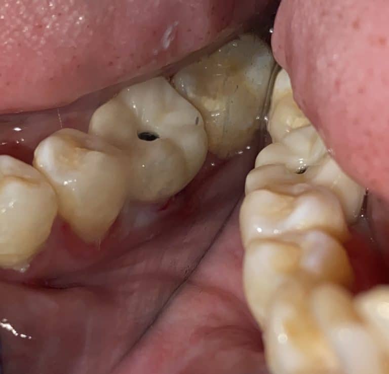 After Image: Single Implant Placement in Posterior Region - front