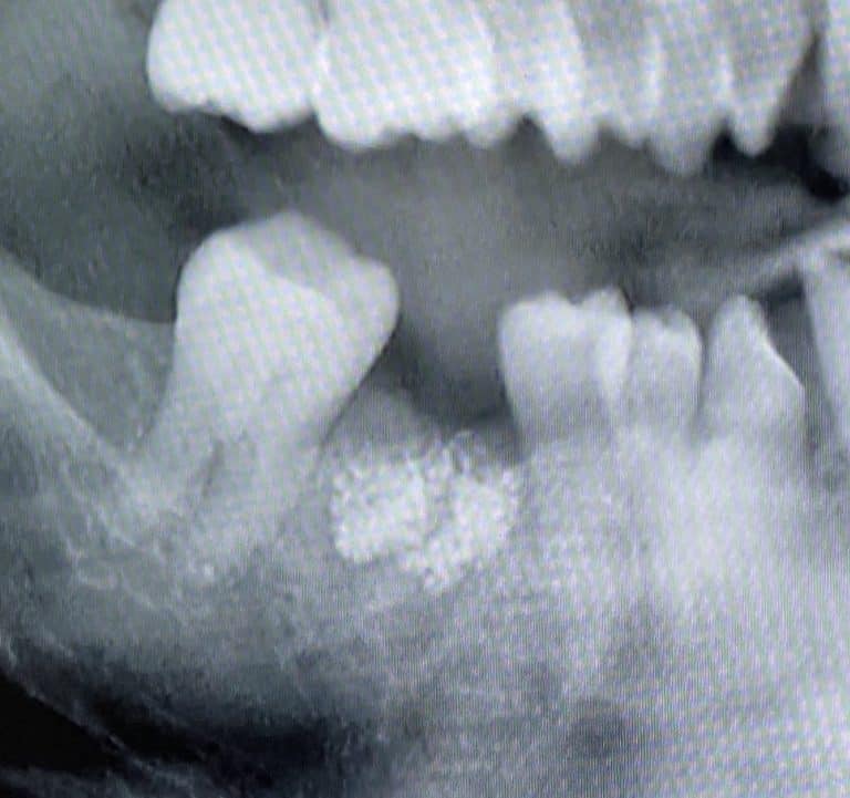 Before Image: Single Implant Placement in Posterior Region - front
