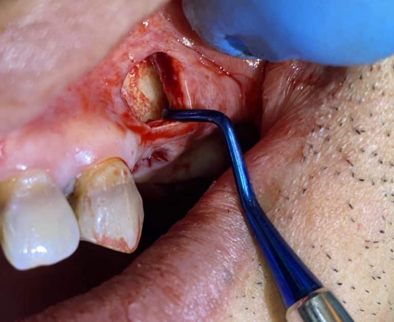 After Image: *Graphic Image* Bone Block Graft Harvested from Lower Jaw to Upper Left Quadrant - front
