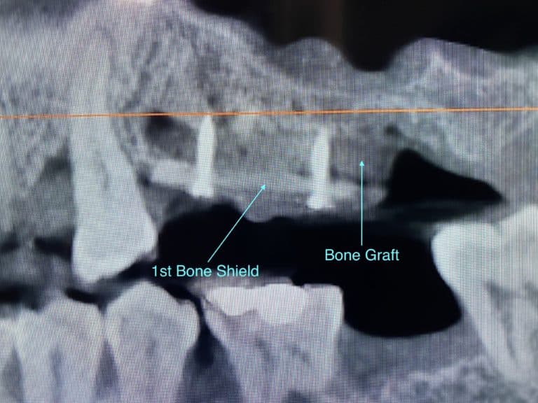 After Image: *Graphic Image* Bone Block Graft Harvested from Lower Jaw to Upper Left Quadrant - front