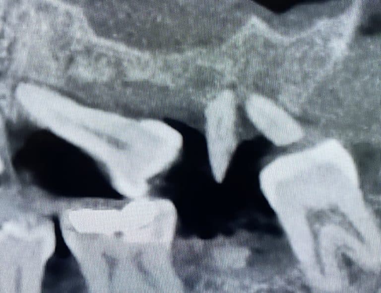 Before Image: *Graphic Image* Bone Block Graft Harvested from Lower Jaw to Upper Left Quadrant - front
