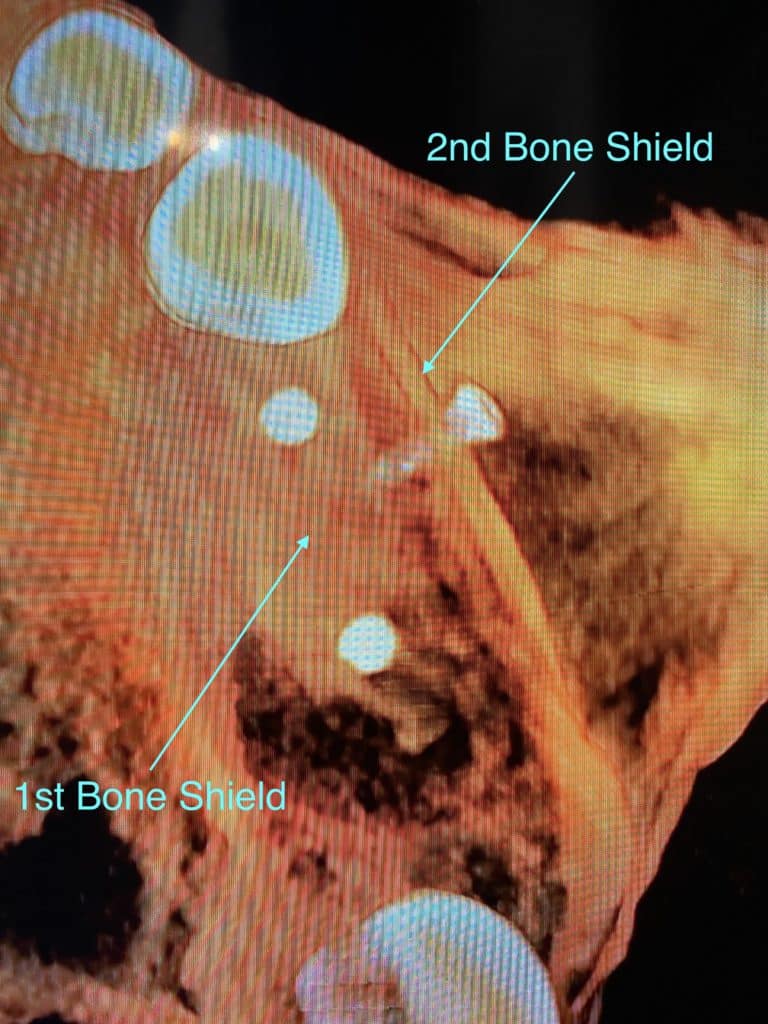 After Image: *Graphic Image* Bone Block Graft Harvested from Lower Jaw to Upper Left Quadrant - front