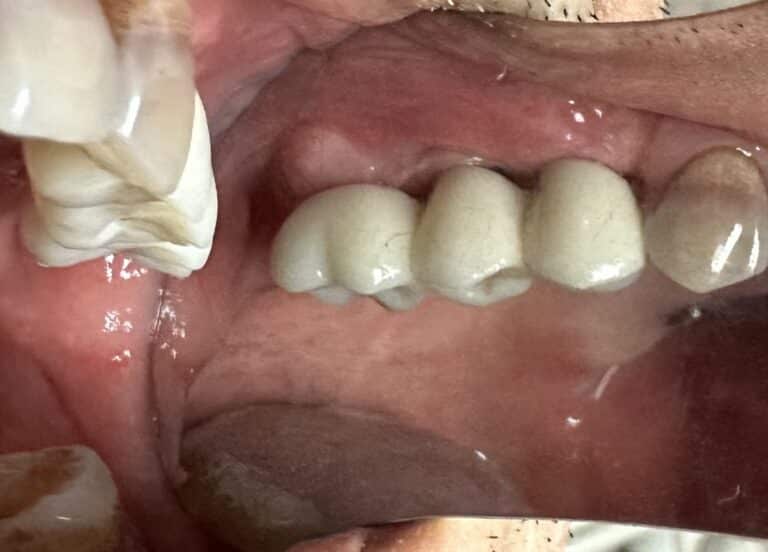 After Image: *Graphic Image* Bone Block Graft Harvested from Lower Jaw to Upper Left Quadrant - front