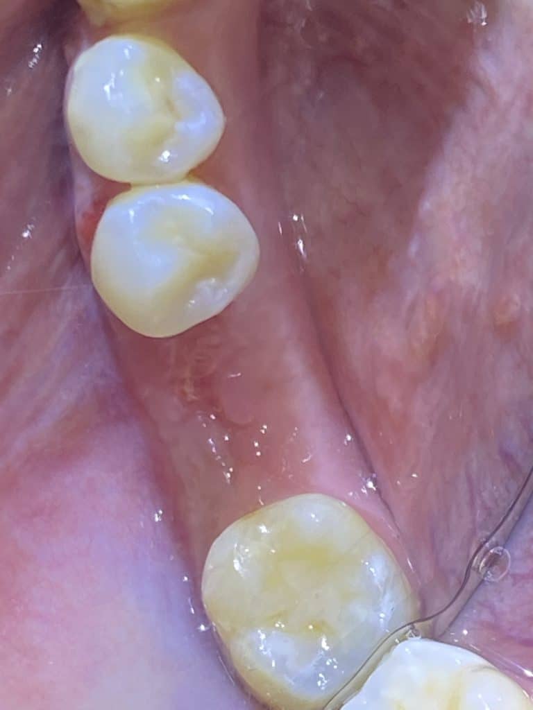 Before Image: Single Implant Placement in Posterior Region - front