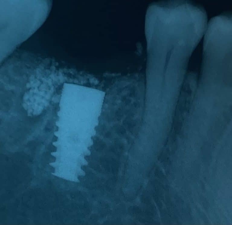 After Image: Single Implant Placement in Posterior Region - front