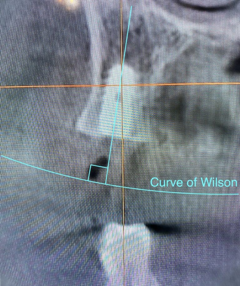 After Image: Upgrading to a Full-Arch Prosthesis with 6 Additional Implants undergoing Flapless Surgery - front