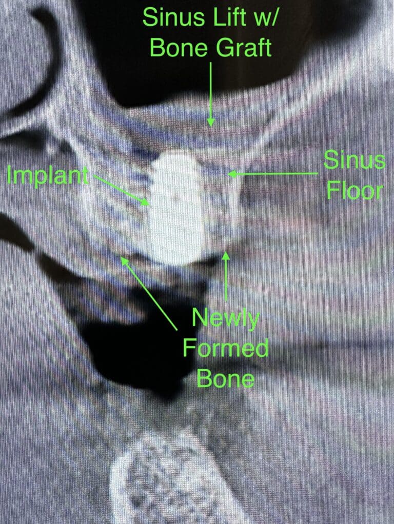 After Image: *Graphic Image* Bone Block Graft Harvested from Lower Jaw to Upper Left Quadrant - front