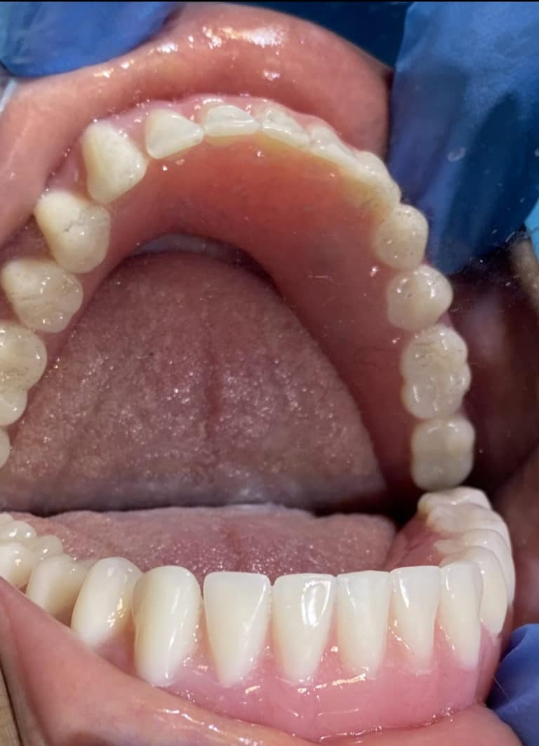 After Image: *Graphic Image* Ridge Splitting Procedure on a Very Thin Ridge of the Lower Arch with 4 Implants Removable Overdenture (Snap-on) Oral Prosthesis - front