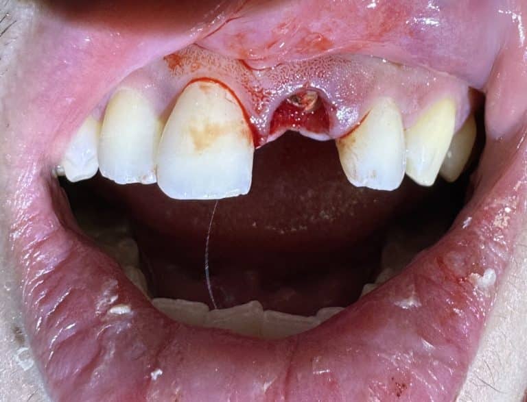 Before Image: Extraction of Broken Anterior Tooth with Immediate Placement of Implant & Temporary Crown - front