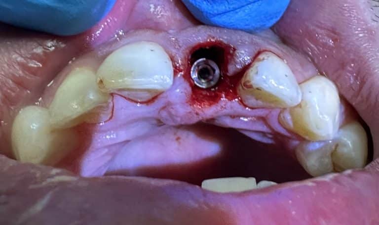After Image: Extraction of Broken Anterior Tooth with Immediate Placement of Implant & Temporary Crown - front