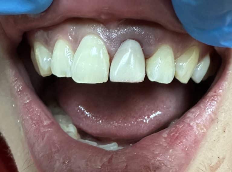 After Image: Extraction of Broken Anterior Tooth with Immediate Placement of Implant & Temporary Crown - front