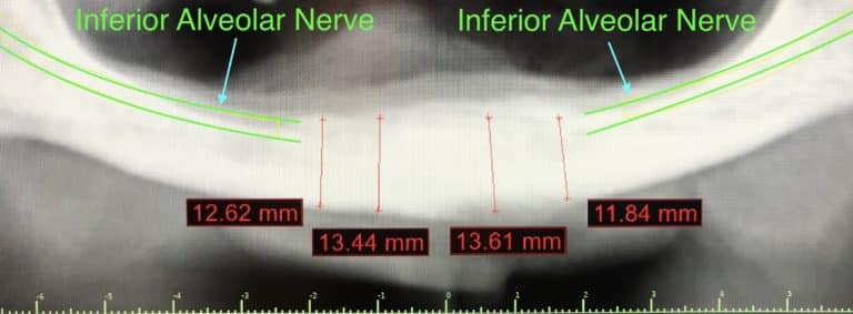 Before Image: Fixed Detachable Implant Prosthesis (OD-4 & RP-4 Implant Overdenture with Fixed Connecting Bar) - front