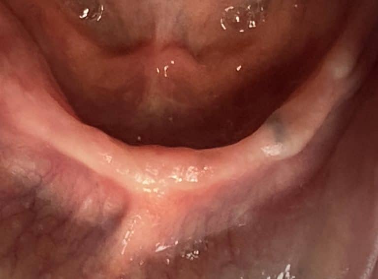 Before Image: *Graphic Image* Ridge Splitting Procedure on a Very Thin Ridge of the Lower Arch with 4 Implants Removable Overdenture (Snap-on) Oral Prosthesis - front