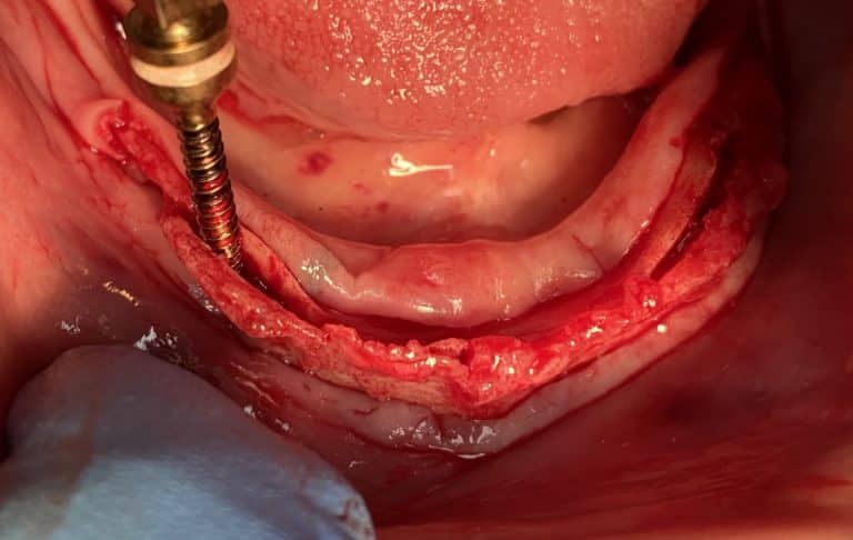 After Image: *Graphic Image* Ridge Splitting Procedure on a Very Thin Ridge of the Lower Arch with 4 Implants Removable Overdenture (Snap-on) Oral Prosthesis - front