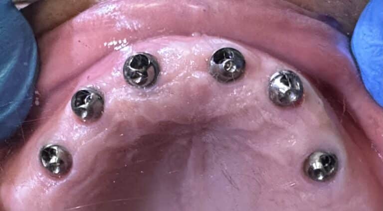 After Image: *Graphic Images* Ridge Splitting Procedure and Bone Expansion with 6 Implant Placements and Upper Full-Arch Fixed Screw-Retained All-on-6 Hybrid Implant Prosthesis - front