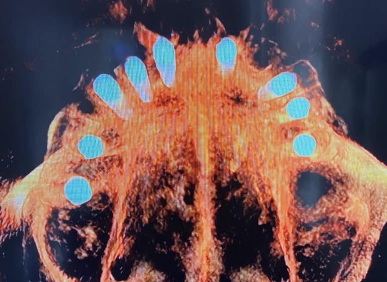 After Image: Upper Full-Arch Extractions with Immediate Placement of Implants - front
