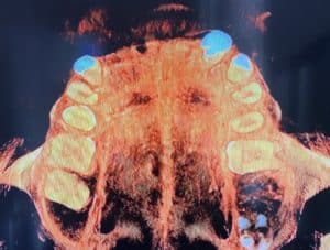 Before Image: Upper Full-Arch Extractions with Immediate Placement of Implants