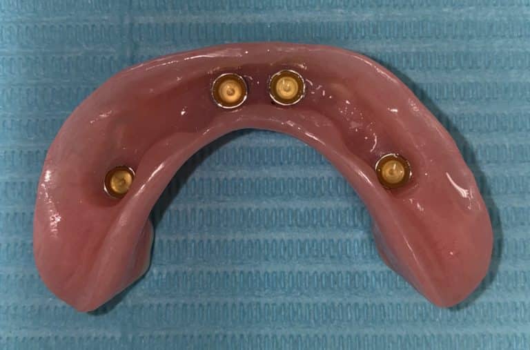 After Image: Fixed Detachable Implant Prosthesis (OD-4 & RP-4 Implant Overdenture with Fixed Connecting Bar) - front