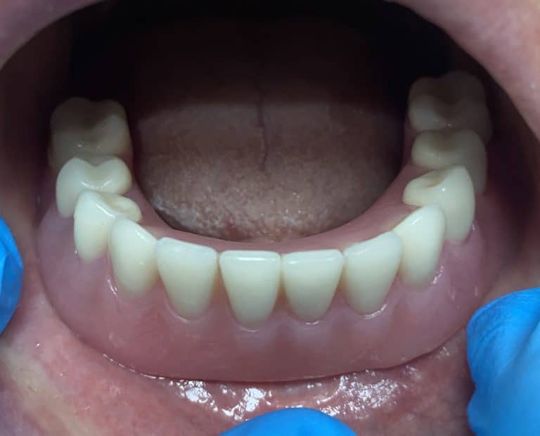 After Image: Fixed Detachable Implant Prosthesis (OD-4 & RP-4 Implant Overdenture with Fixed Connecting Bar) - front