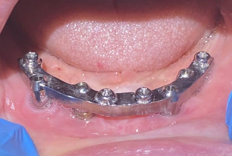 After Image: Fixed Detachable Implant Prosthesis (OD-4 & RP-4 Implant Overdenture with Fixed Connecting Bar) - front