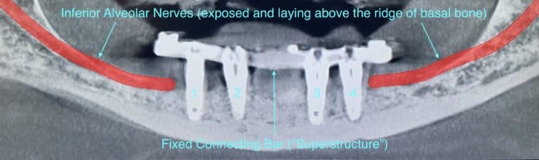 After Image: Fixed Detachable Implant Prosthesis (OD-4 & RP-4 Implant Overdenture with Fixed Connecting Bar) - front