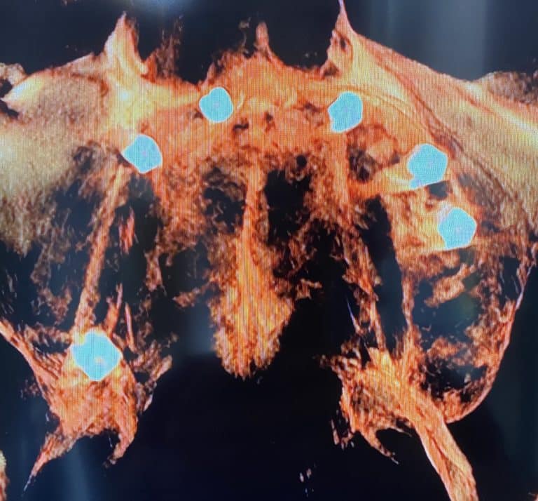 After Image: Ridge Splitting Procedure on a Severely Deficient Maxillary Alveolar Ridge with Multiple Implant Placements - front