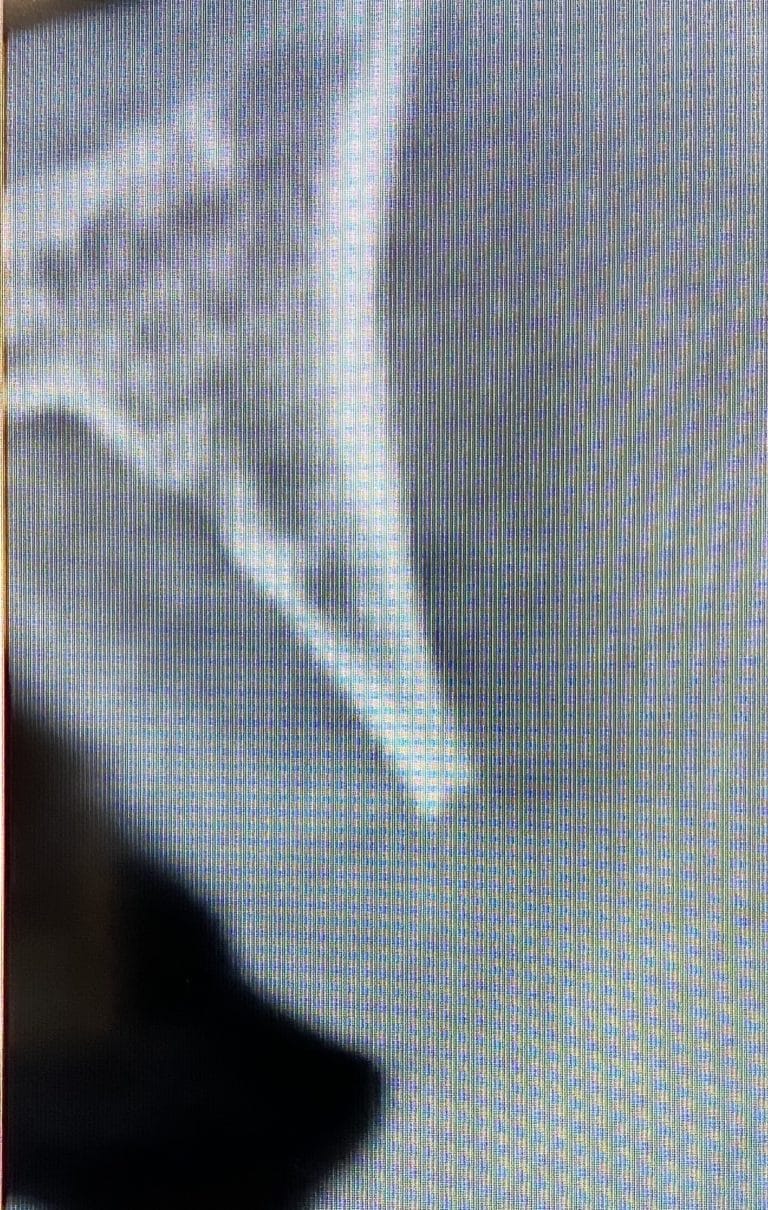 Before Image: Ridge Splitting Procedure on a Severely Deficient Maxillary Alveolar Ridge with Multiple Implant Placements - front