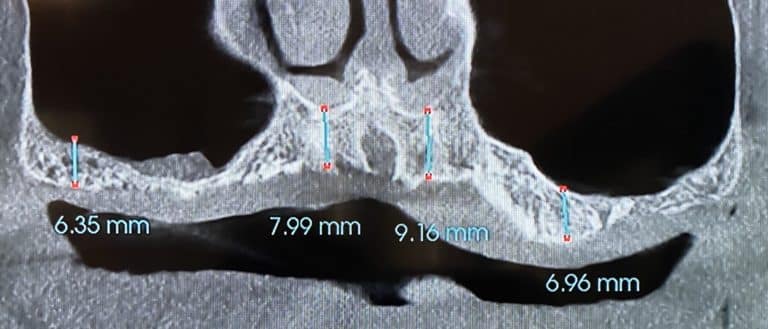 Before Image: Ridge Splitting Procedure on a Severely Deficient Maxillary Alveolar Ridge with Multiple Implant Placements - front