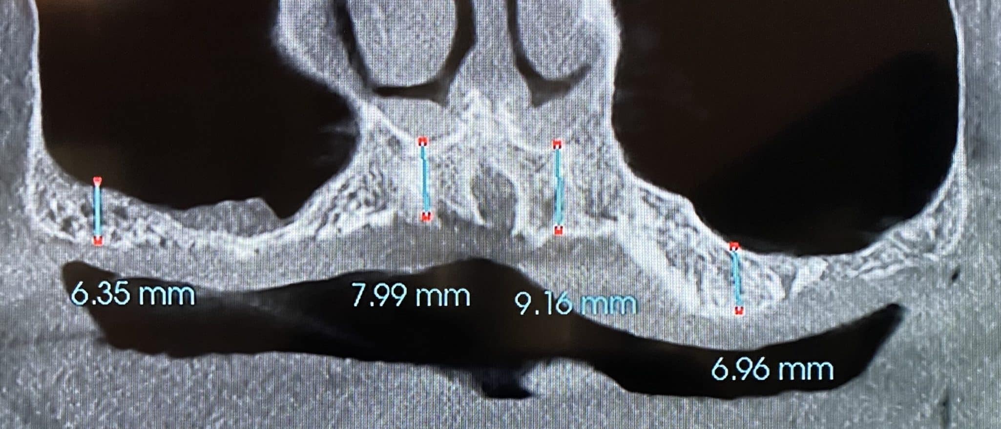 Ridge Splitting Procedure on a Severely Deficient Maxillary Alveolar Ridge with Multiple Implant Placements