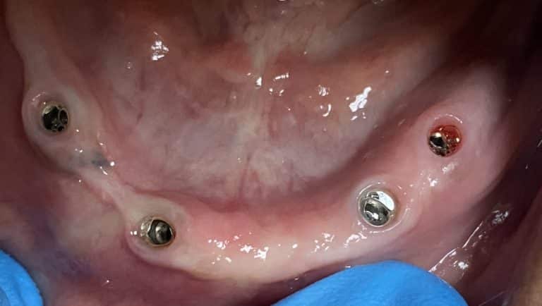 After Image: *Graphic Image* Ridge Splitting Procedure on a Very Thin Ridge of the Lower Arch with 4 Implants Removable Overdenture (Snap-on) Oral Prosthesis - front
