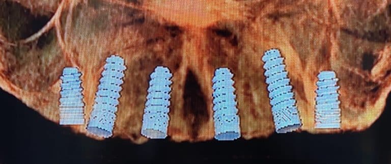 Before Image: *Graphic Images* Ridge Splitting Procedure and Bone Expansion with 6 Implant Placements and Upper Full-Arch Fixed Screw-Retained All-on-6 Hybrid Implant Prosthesis - other