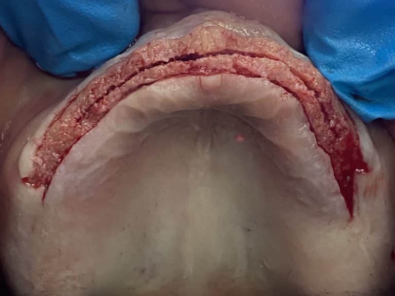 After Image: *Graphic Images* Ridge Splitting Procedure and Bone Expansion with 6 Implant Placements and Upper Full-Arch Fixed Screw-Retained All-on-6 Hybrid Implant Prosthesis - other